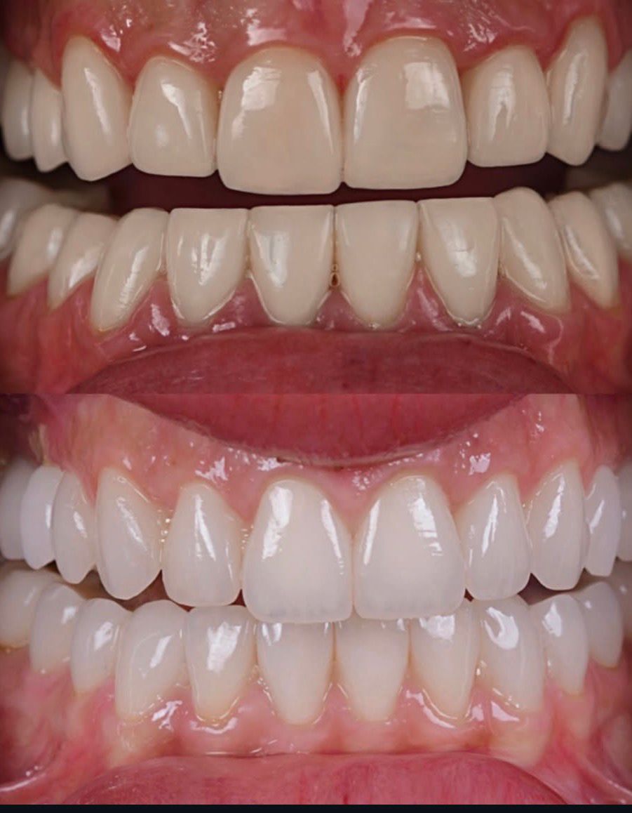 Before and after comparison of a complete smile makeover treatment